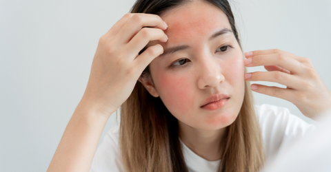 Best Natural Ingredients To Treat Rosacea