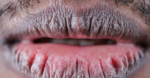 How to Get Rid of Chapped Lips