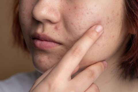 Understanding the Causes and Symptoms of Fungal Acne