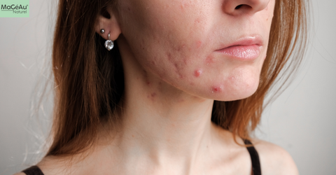 Acne