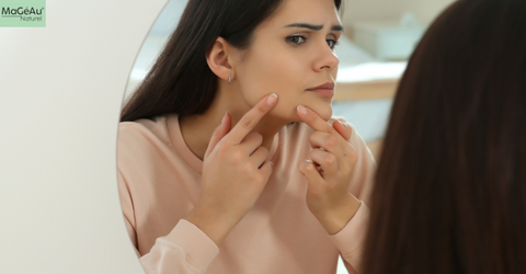 Struggling with Jawline Acne? Here’s What Might Be Triggering It