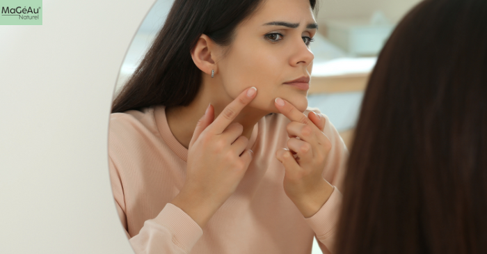 Struggling with Jawline Acne? Here’s What Might Be Triggering It