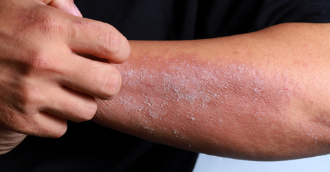 Managing Dry Hands Caused by Eczema