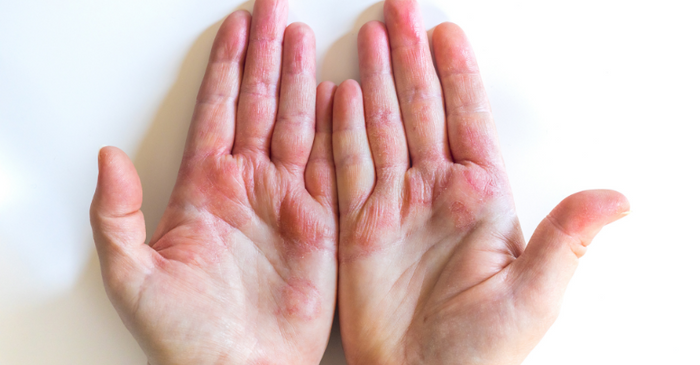 Eczema vs Dermatitis