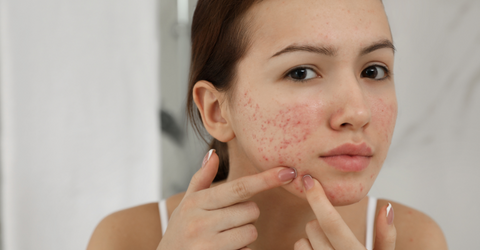 5 Best and Simple Steps to Prevent Fungal Acne