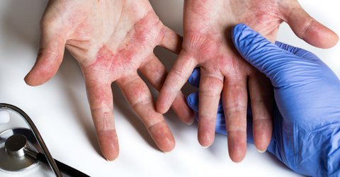 What is Atopic Dermatitis? Detailed Instructions