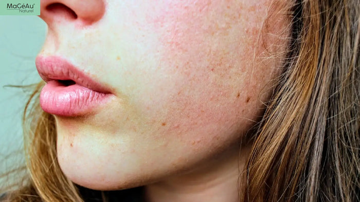 Perioral Dermatitis 101: How It's Different From Sensitive Skin