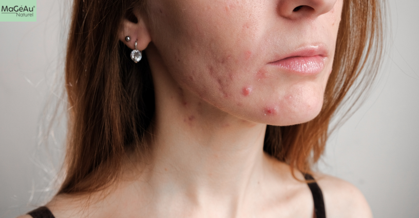 Acne