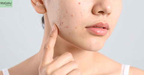 From Acne to Rosacea: Decoding Your Skin's SOS Signals