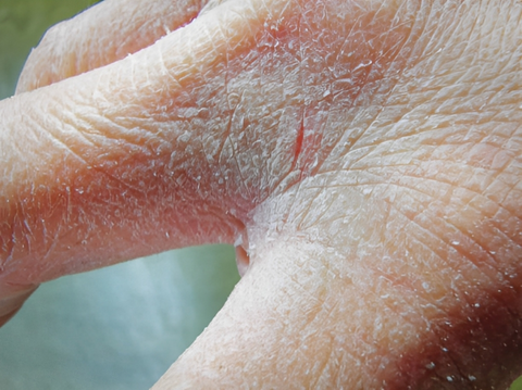 7 Simple Tips and Strategies for Preventing Cracked Hands