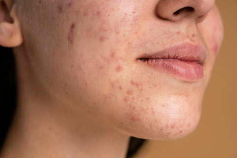 Best Fungal Acne Treatment: How to Get Rid of It?
