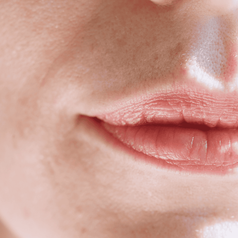 Chapped & Sun-Sensitive Lips